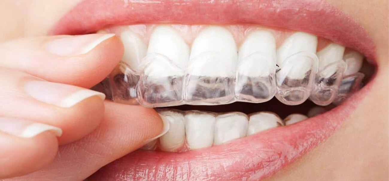 ارتودنسی، بهترین روش زیبایی دندان